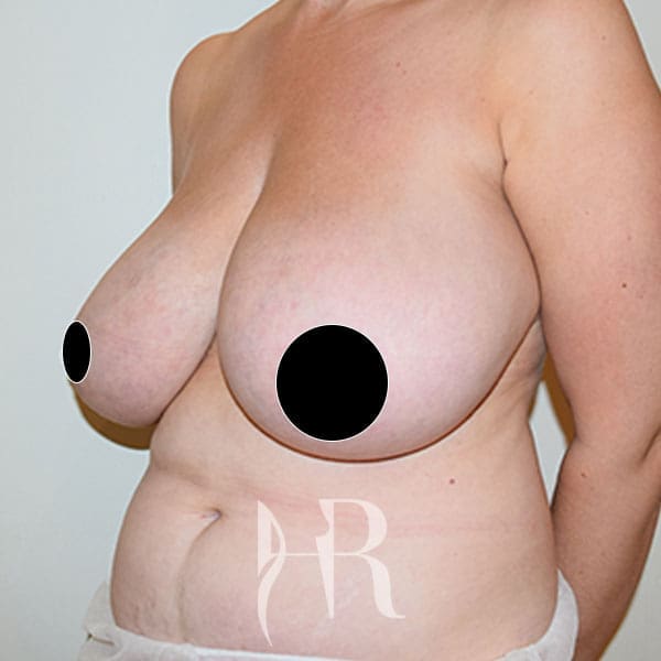 HR Plastic Surgery - Breast Reduction patient before 9